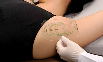 川越のワキガ治療ミラドライにおけるマーキングと精密な照射イメージ