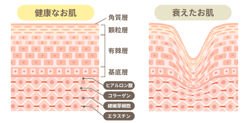 健康な肌と音添えた肌の組織図
