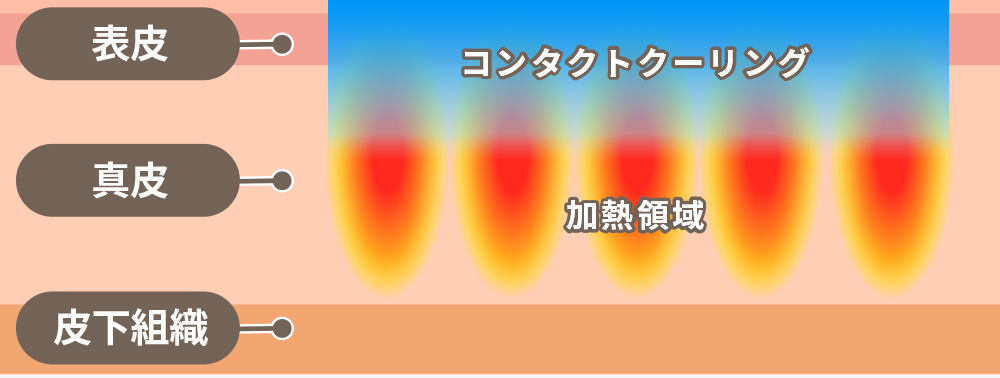 ソフウェーブの仕組みの詳細画像