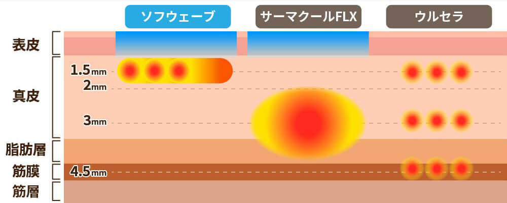 ソフウェーブと他の治療の比較画像