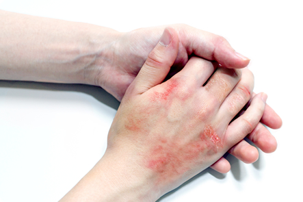 荒れる 手のひら 手が皮膚がボロボロとむける症状と原因と対策方法とは？ストレス、それとも病気？