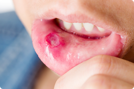 ステージ0の口唇がん