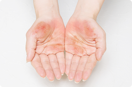 むける が の 手 ストレス 皮 手の皮が剥ける4つの原因と対処法まとめ