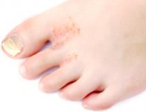 手や足のブツブツ 皮むけ 汗疱 掌蹠膿疱症 坂戸市にっさい花みず木