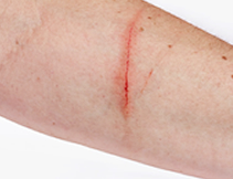 すり傷 切り傷 やけど キズあと 坂戸市にっさい花みず木